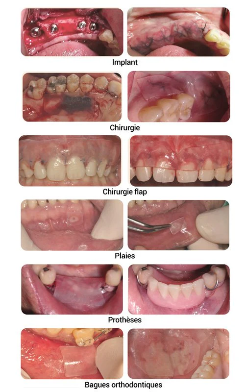 Ora-Aid pansement intra-oral - Boîte de 20 (25 x 15 mm) | MATBEKA – Image 5